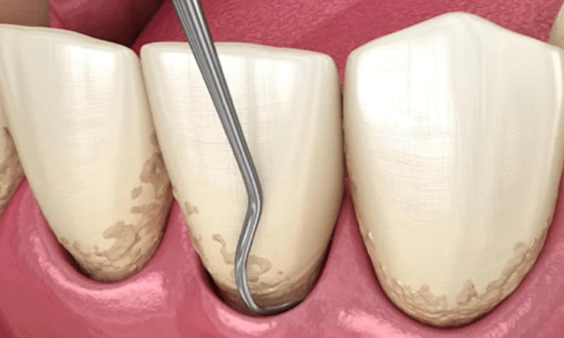 下松市（山口県）の歯医者、たけなわ歯科口腔外科クリニックのクリーニング