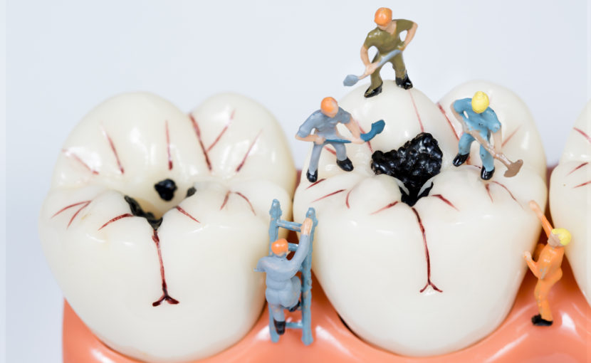 下松市（山口県）の歯医者、たけなわ歯科口腔外科クリニックのむし歯（う蝕）治療