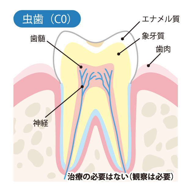 下松市(山口県)の歯医者、たけなわ歯科口腔外科クリニックのむし歯治療