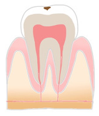 下松市（山口県）の歯医者、たけなわ歯科口腔外科クリニックのむし歯（う蝕）治療