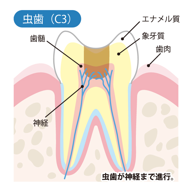 下松市(山口県)の歯医者、たけなわ歯科口腔外科クリニックのむし歯治療