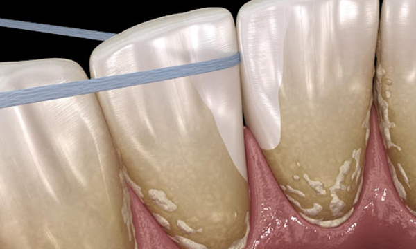 下松市（山口県）の歯医者、たけなわ歯科口腔外科クリニックのクリーニング