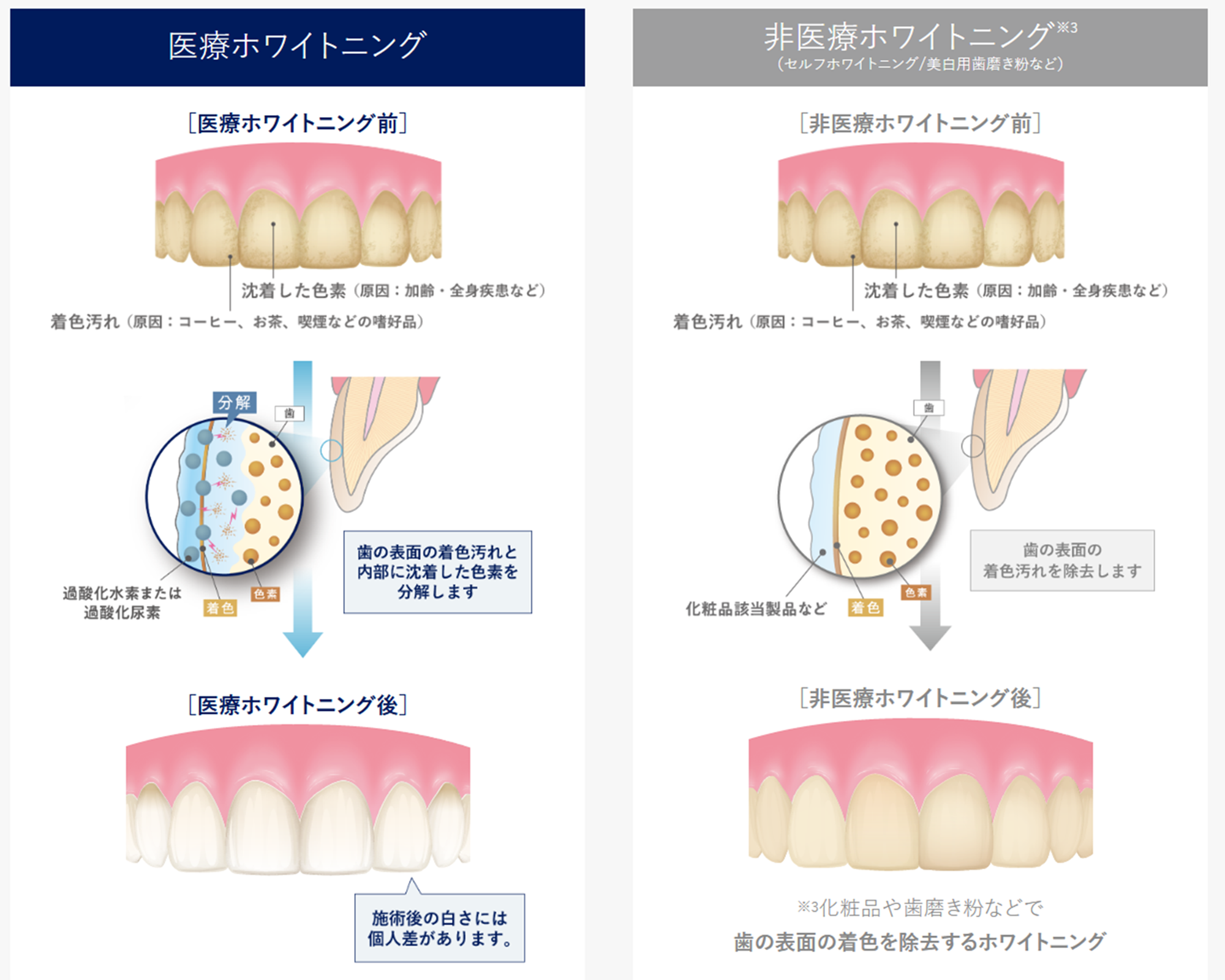 下松市（山口県）の歯医者、たけなわ歯科口腔外科クリニックのホワイトニング